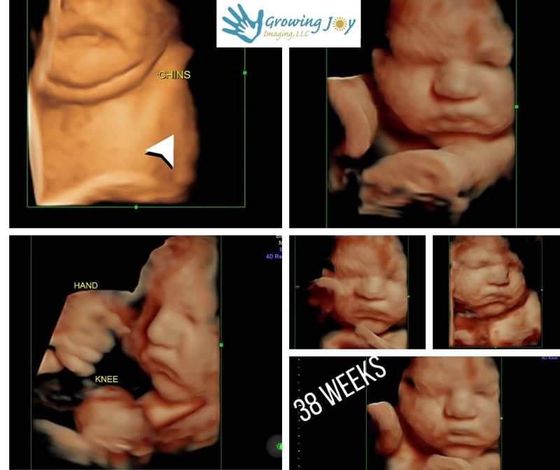 Prenatal Elective Ultrasound